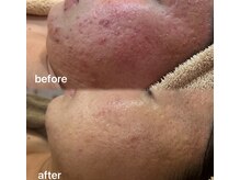 ベリス(BELLIS)/長年悩みのニキビケアもハーブで