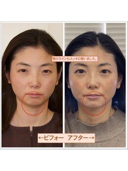 ビューティーパンク 黒田鍼治療院(Beauty Punc)/二重顎?