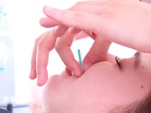 ムーブアクト 福山店(Moveact)/美容鍼/鍼灸/針灸/小顔矯正