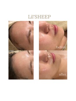 リルシープ(LIL'SHEEP)/エクソソームハーブピーリング