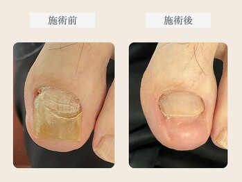 ルポ 伊勢/肥厚爪の修復