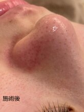 ルフ エステティック ビューティー(ruf esthetic beauty)/毛穴洗浄 施術後