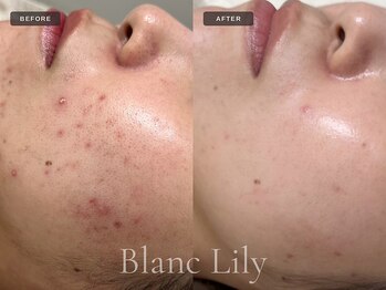 ブランリリー 福岡薬院店(Blanc Lily)の写真/【薬院の人気サロン】乾燥・赤み・ニキビ、敏感肌など季節特有の“ゆらぎ肌”にお悩みの方に☆