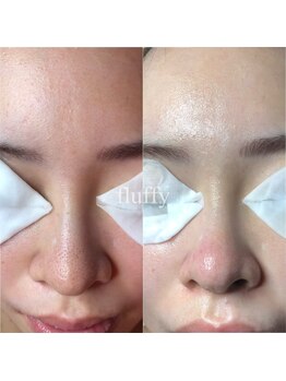 フラフィ 宇都宮本店(fluffy)/黒ずみにお悩みのお客様【毛穴】