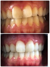 アン リオン(UN LiON)/セルフホワイトニング