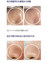 エミルカ 自由が丘店(EMILUCA)/気になっていた顔の毛穴詰まり