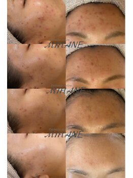 海羽/ニキビ改善ならハーブピーリング