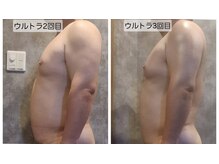 ヴィトワ(Vitowa)/ウルトランスフォーマー施術例9