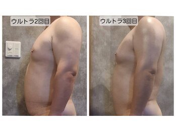 ヴィトワ(Vitowa)/ウルトランスフォーマー施術例9