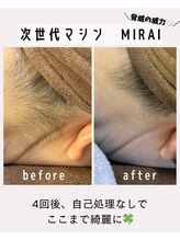 ナゴミ 金沢店(nagomi)/【効果重視型脱毛MIRAIを使用】