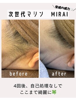 ナゴミ 金沢店(nagomi)/【効果重視型脱毛MIRAIを使用】