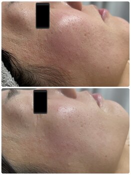 ラン(Ran)/ホワイトスノーピール