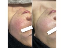 サロン ド ビューティージュエル(salon de beauty JEWEL)/光フェイシャル8回