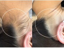 アンベリール(Embellir)/W脱毛／1回目→2回目