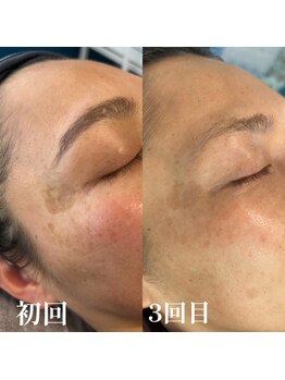 ボーホーアフロ(BOHO AFRO)の写真/秋の美肌ケア★産毛も古い確実もすっきりOFF！WAX&光フォトで素肌から輝くツヤ肌◎