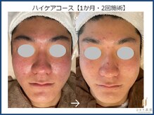 ひかり素肌/ハイケアコース 1か月