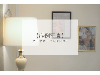 ライム 吉祥寺(LIME)/ハーブピーリング｜症例写真