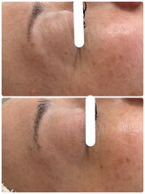 アンド ユー(and.yu)/シミケア・美肌コース1回　