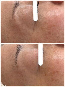 アンド ユー(and.yu)/シミケア・美肌コース1回　