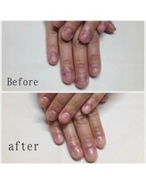 ティアラネイル 宇都宮/深爪矯正