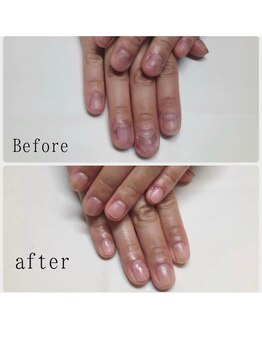 ティアラネイル 宇都宮/深爪矯正