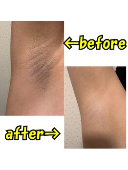 ルルマル(LuLu MaLu)/ワキ脱毛 BeforeAfter 8回目