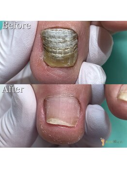 巻き爪補正店 柏店/変形爪再生補正1指¥5500