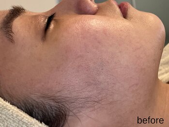 サロン ド エメ(salon de aimer)/【Before】本格エイジングケアに