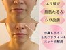 《6月のキャンペーン》リピ-タ-様もお久しぶりの方もOK◎小顔矯正x鼻毛穴洗浄