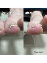 北区天神橋巻き爪センター/巻き爪