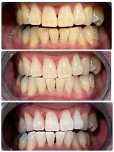 エクシアホワイトニング 日本橋店/経過写真