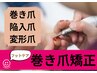 【再来限定】巻き爪/陥入爪/変形爪/肥厚爪/爪切り/タコ/ウオノメ