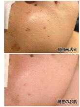 レイール(Reir)/フォト美顔