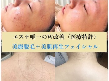 ナチュレアンドメディカ(Nature&Medica)の写真/エステでは叶わない圧倒的な脱毛効果と美肌力！唯一のフェイシャル付Ｗ改善は毛穴、シミ、ニキビも同時ケア