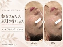 ウィンク 勝どき(wink)の雰囲気（ハーブピーリングは毎月、時期に合わせたキャンペーンを実施中！）