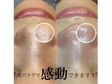 ピエル 北千住店(PIEL)/毛穴ケアで感動できます
