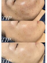 エル(Elle)/【エイジングケア】シミやくすみ