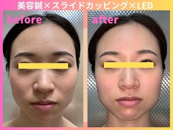 サーズ(SA’S)/美容鍼 ベーシックコース施術