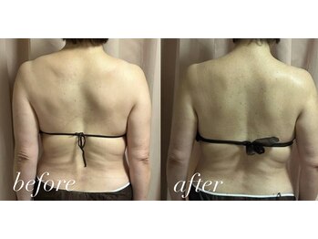 リシェカ(Richeka)/盛り上がった肩まわりの変化