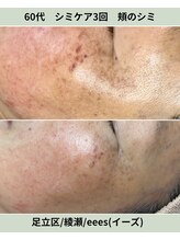 イーズ(eees)/頬のシミケア