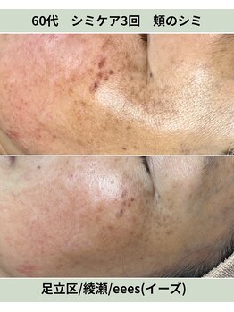 イーズ(eees)/頬のシミケア