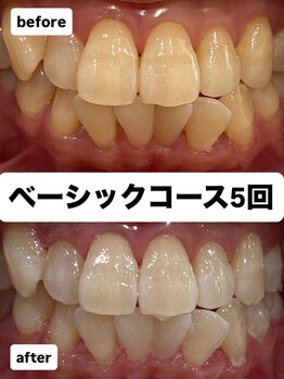 トータルビューティー エヌ プラス(total beauty n+)/ベーシック５回コース
