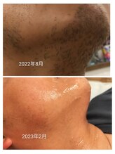 サロン ド ベルポ 高崎上並榎店(salon de bellpo.)/脱毛後の驚きの変化【高崎/脱毛