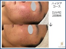 ひかり素肌/ハイケアコース 1か月