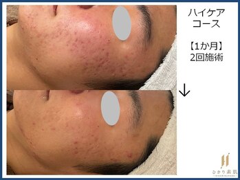ひかり素肌/ハイケアコース 1か月
