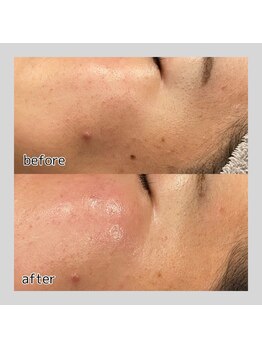 アデル 久留米(ADEL)/《全顔》目元、頬ワックス