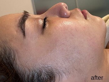 サロン ド エメ(salon de aimer)/【After】圧倒的な変化!美肌!