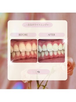 プラスビー 2号店(+b)/ホワイトニングビフォーアフター