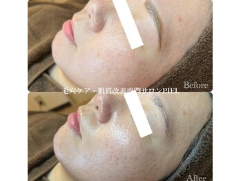 ピエル 北千住店(PIEL)/乳酸菌配合トリートメント