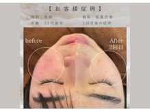 肌質改善の変化です☆